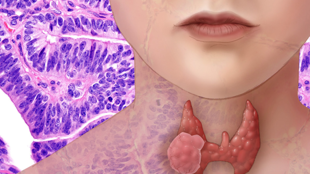 Thyroid cancer in Fukushima children increased 20-fold | Beyond Nuclear ...